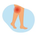 하지정맥류 예방법